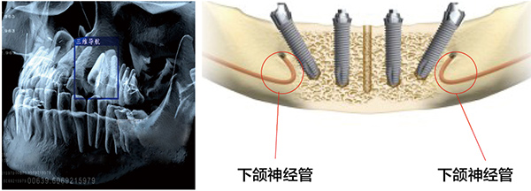 三维CT口腔影像数据捕获