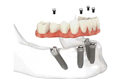 All-on-4种植牙 苏州美奥口腔