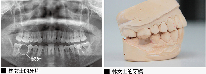 林女士的牙片和牙模-美奥口腔